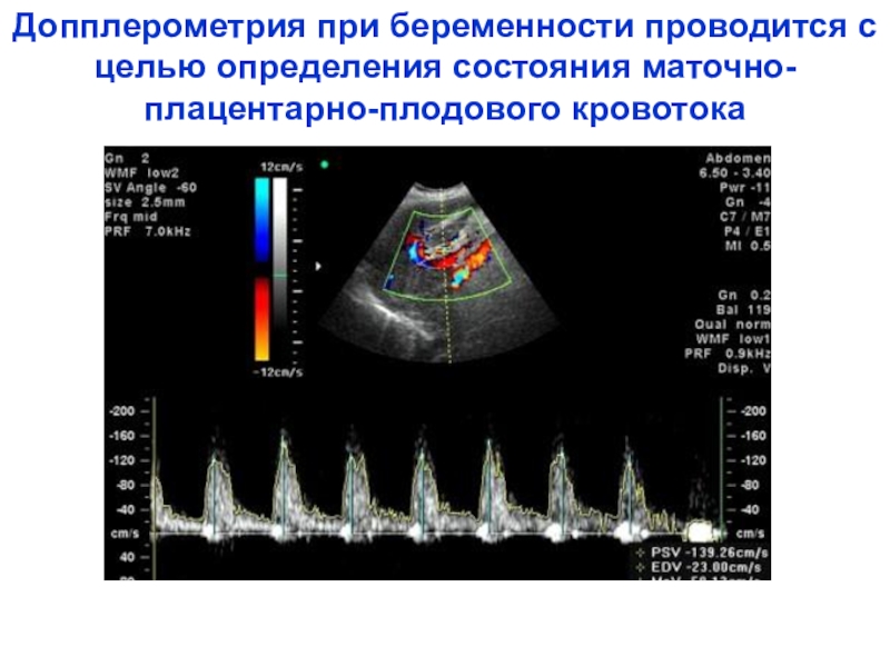 Доплер это во время. УЗИ С допплерометрией норма. Допплер кровотока при беременности. Норма кровотока допплер плода. УЗИ допплерография маточно плацентарного.