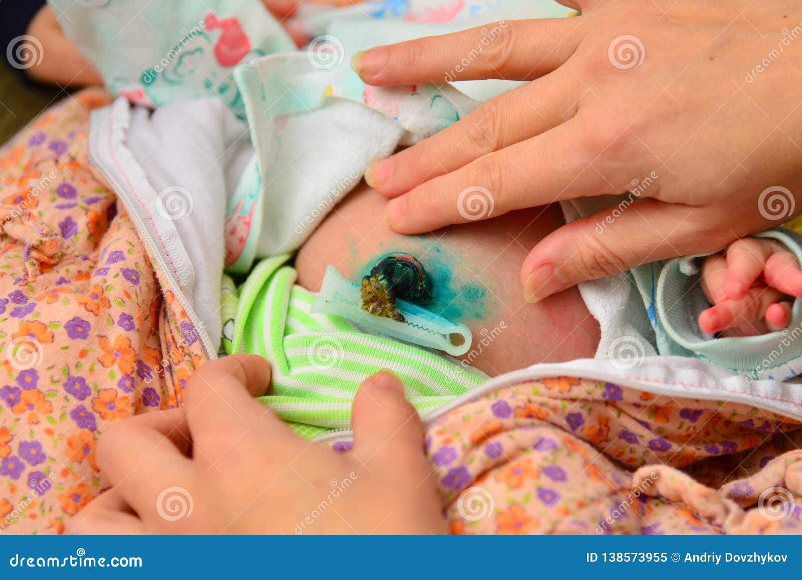 пуповина новорожденного фото