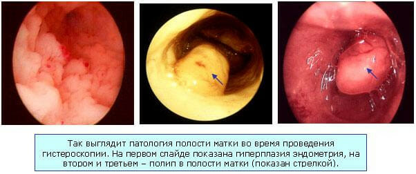 Гиперплазия эндометрия и полипы в матке