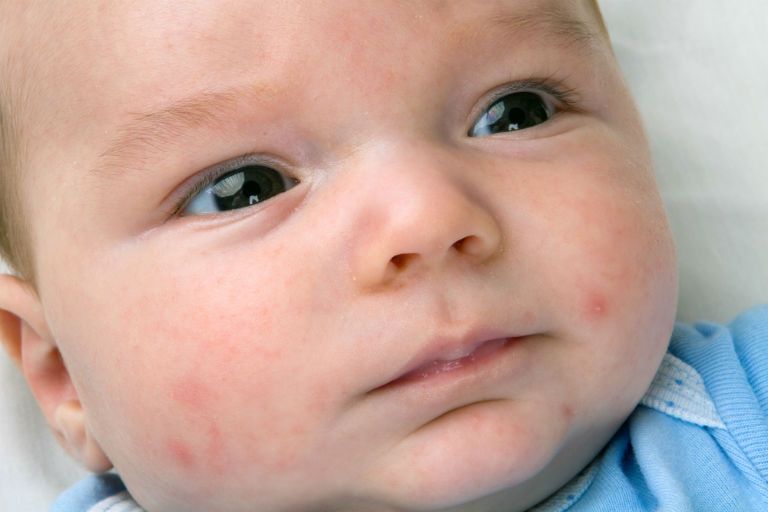 Сыпь на лице у новорожденного 1 месяц причины и лечение
