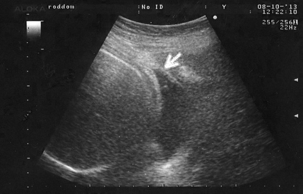 Операция рубца на матке. УЗИ рубца на матке после кесарева при беременности. Рубец на матке при беременности УЗИ. УЗИ рубца на матке после кесарева.