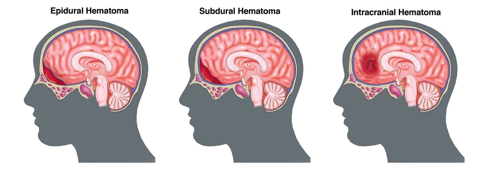 Hominick Hematoma