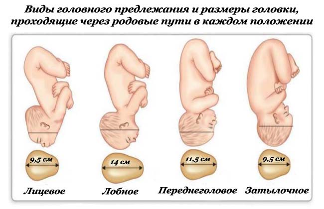 Головное предлежание плода