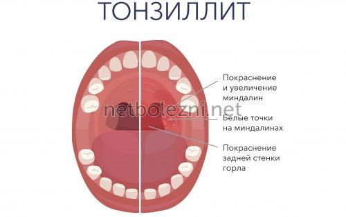 Как быстро избавиться от першения в горле в домашних условиях. Першит в горле —, что делать. Лечение 05